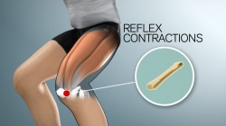 Compex